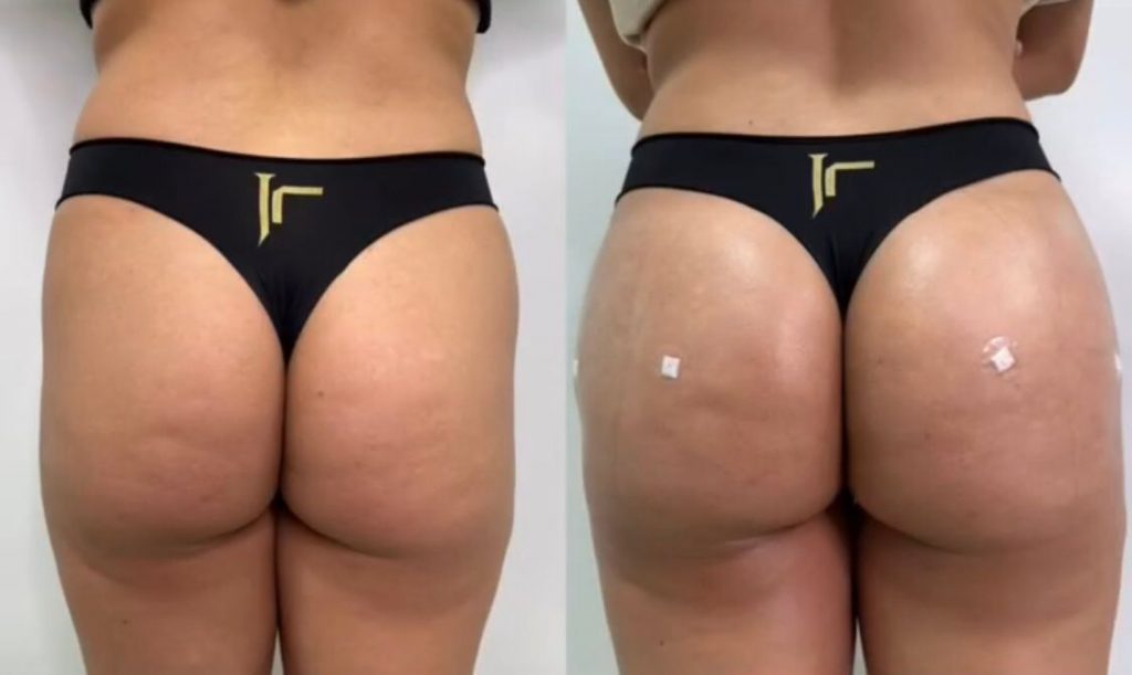 Antes e depois do método de harmonização de glúteos