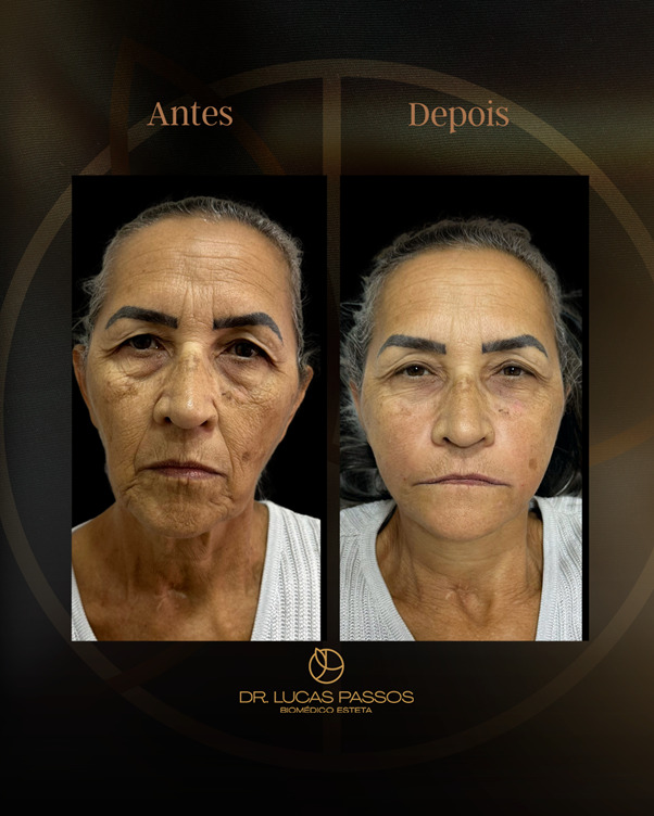 Antes e Depois
